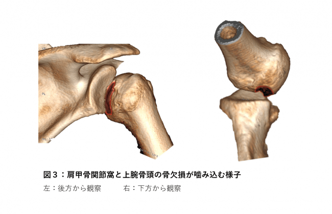 【図３】肩甲骨関節窩と上腕骨頭の骨欠損が噛み込む様子